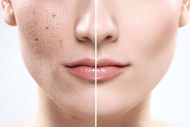 Điều Trị Giãn Mau Mạch, Phục Hồi Hư Tổn