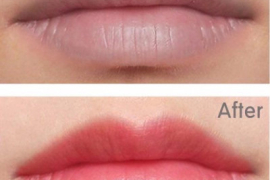 Xóa Thâm, Xử Lý Thâm Loang